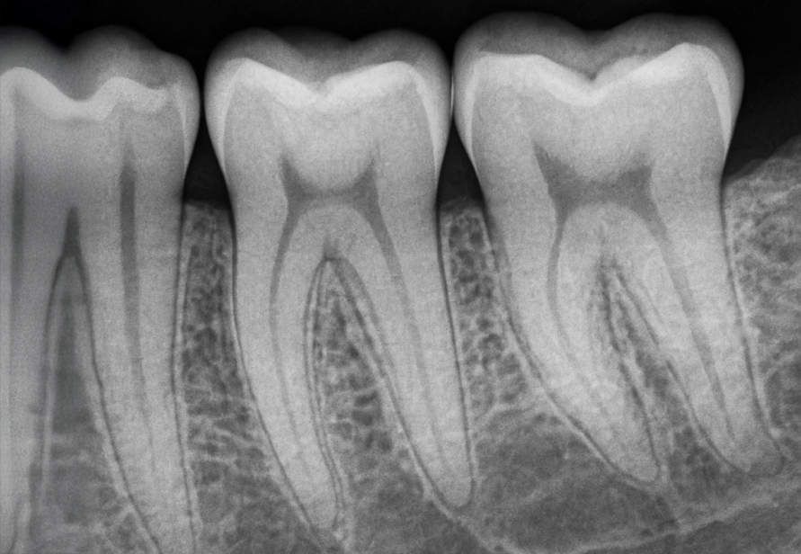 radiographie d'une dent